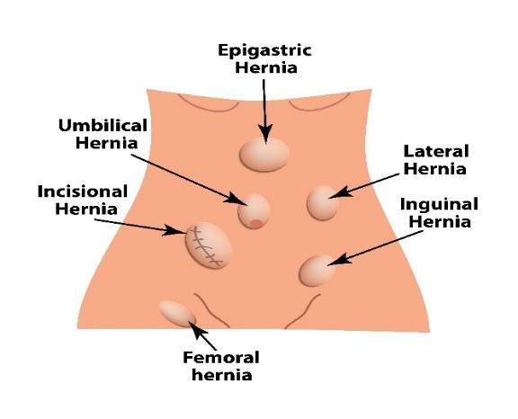 TEMA 2. CIRUGÍA DE LA PARED ABDOMINAL