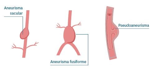 TEMA 1 CIRUG A VASCULAR ANATOM A Y PATOLOG AS M S COMUNES TEMA 1 CIRUG A VASCULAR ANATOM A Y PATOLOG AS M S COMUNES
