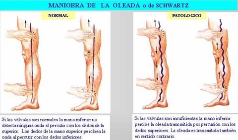 TEMA 6 DIAGN STICO DIFERENCIAL DE LA ULCERA VENOSA EN MIEMBRO INFERIOR