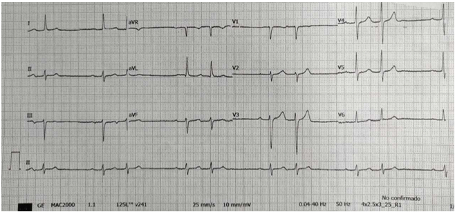 TEMA 4 ARRITMIAS SUPRAVENTRICULARES TEMA 4 ARRITMIAS SUPRAVENTRICULARES